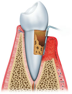 Periodontal Disease